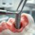 Implantologia stomatologiczna – co warto wiedzieć o implantach?